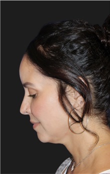 Neck Lift Before Photo by Munique Maia, MD; Tysons Corner, VA - Case 49360