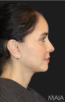 Neck Lift After Photo by Munique Maia, MD; Tysons Corner, VA - Case 49360