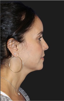 Neck Lift Before Photo by Munique Maia, MD; Tysons Corner, VA - Case 49360