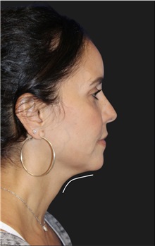 Neck Lift Before Photo by Munique Maia, MD; Tysons Corner, VA - Case 49360