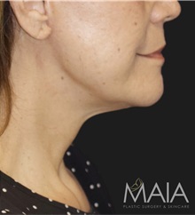 Neck Lift After Photo by Munique Maia, MD; Tysons Corner, VA - Case 49358