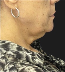 Neck Lift Before Photo by Munique Maia, MD; Tysons Corner, VA - Case 49358