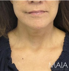 Neck Lift After Photo by Munique Maia, MD; Tysons Corner, VA - Case 49358