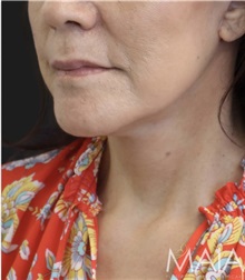 Neck Lift After Photo by Munique Maia, MD; Tysons Corner, VA - Case 49358