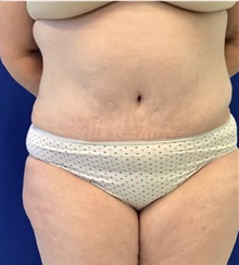 Tummy Tuck After Photo by Munique Maia, MD; Tysons Corner, VA - Case 49354