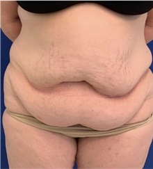 Tummy Tuck Before Photo by Munique Maia, MD; Tysons Corner, VA - Case 49354