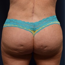 Buttock Lift with Augmentation After Photo by Michael Frederick, MD; Fort Lauderdale, FL - Case 35874