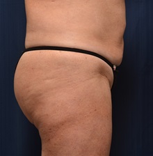 Buttock Lift with Augmentation Before Photo by Michael Frederick, MD; Fort Lauderdale, FL - Case 35874