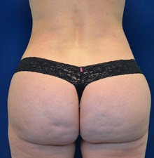 Buttock Lift with Augmentation After Photo by Michael Frederick, MD; Fort Lauderdale, FL - Case 35875