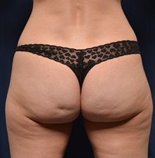 Buttock Lift with Augmentation Before Photo by Michael Frederick, MD; Fort Lauderdale, FL - Case 35875