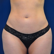 Buttock Lift with Augmentation After Photo by Michael Frederick, MD; Fort Lauderdale, FL - Case 35875
