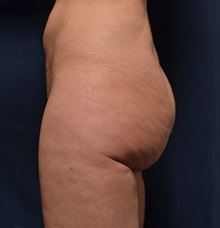 Buttock Lift with Augmentation Before Photo by Michael Frederick, MD; Fort Lauderdale, FL - Case 35876