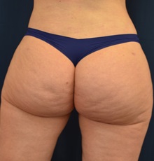 Buttock Lift with Augmentation After Photo by Michael Frederick, MD; Fort Lauderdale, FL - Case 35876