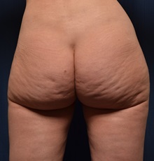 Buttock Lift with Augmentation Before Photo by Michael Frederick, MD; Fort Lauderdale, FL - Case 35876