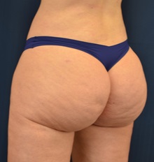 Buttock Lift with Augmentation After Photo by Michael Frederick, MD; Fort Lauderdale, FL - Case 35876