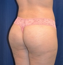Buttock Lift with Augmentation After Photo by Michael Frederick, MD; Fort Lauderdale, FL - Case 35877