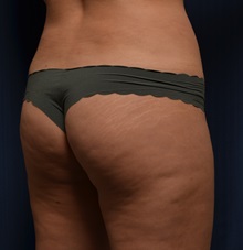 Buttock Lift with Augmentation Before Photo by Michael Frederick, MD; Fort Lauderdale, FL - Case 35877