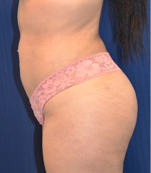 Buttock Lift with Augmentation After Photo by Michael Frederick, MD; Fort Lauderdale, FL - Case 35877