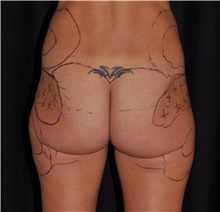 Buttock Lift with Augmentation Before Photo by Michael Frederick, MD; Fort Lauderdale, FL - Case 35878
