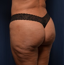 Buttock Lift with Augmentation After Photo by Michael Frederick, MD; Fort Lauderdale, FL - Case 35879