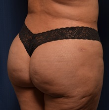 Buttock Lift with Augmentation After Photo by Michael Frederick, MD; Fort Lauderdale, FL - Case 35879