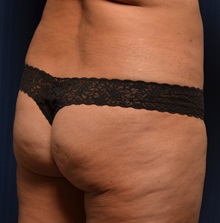 Buttock Lift with Augmentation Before Photo by Michael Frederick, MD; Fort Lauderdale, FL - Case 35879
