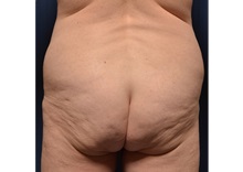 Buttock Lift with Augmentation Before Photo by Michael Frederick, MD; Fort Lauderdale, FL - Case 35880
