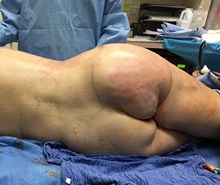 Buttock Lift with Augmentation After Photo by Michael Frederick, MD; Fort Lauderdale, FL - Case 35880