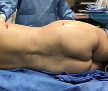 Buttock Lift with Augmentation Before Photo by Michael Frederick, MD; Fort Lauderdale, FL - Case 35880