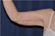 Arm Lift After Photo by Michael Frederick, MD; Fort Lauderdale, FL - Case 35882