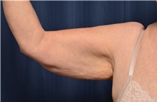 Arm Lift Before Photo by Michael Frederick, MD; Fort Lauderdale, FL - Case 35882