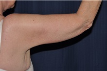 Arm Lift After Photo by Michael Frederick, MD; Fort Lauderdale, FL - Case 35882