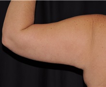 Arm Lift After Photo by Michael Frederick, MD; Fort Lauderdale, FL - Case 35884