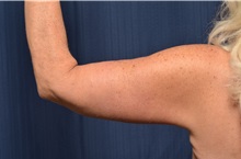 Arm Lift After Photo by Michael Frederick, MD; Fort Lauderdale, FL - Case 35885