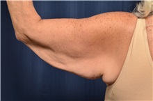 Arm Lift Before Photo by Michael Frederick, MD; Fort Lauderdale, FL - Case 35885