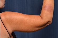 Arm Lift After Photo by Michael Frederick, MD; Fort Lauderdale, FL - Case 35886