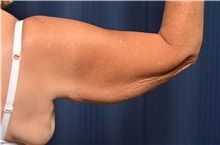 Arm Lift Before Photo by Michael Frederick, MD; Fort Lauderdale, FL - Case 35886