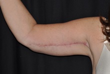 Arm Lift After Photo by Michael Frederick, MD; Fort Lauderdale, FL - Case 35887