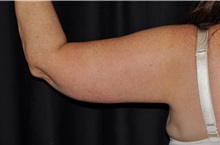 Arm Lift After Photo by Michael Frederick, MD; Fort Lauderdale, FL - Case 35887
