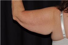 Arm Lift Before Photo by Michael Frederick, MD; Fort Lauderdale, FL - Case 35887