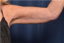 Arm Lift After Photo by Michael Frederick, MD; Fort Lauderdale, FL - Case 35888