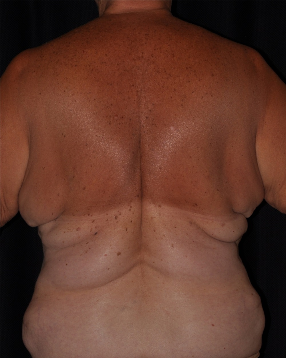 Body Contouring Before and After Photos by Michael Frederick, MD