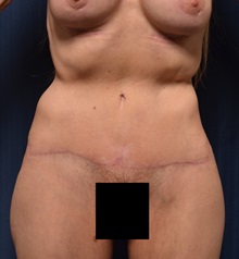 Body Lift After Photo by Michael Frederick, MD; Fort Lauderdale, FL - Case 35891