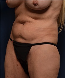 Body Lift Before Photo by Michael Frederick, MD; Fort Lauderdale, FL - Case 35891
