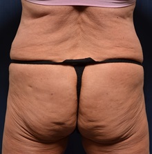 Body Lift Before Photo by Michael Frederick, MD; Fort Lauderdale, FL - Case 35892