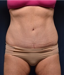 Body Lift After Photo by Michael Frederick, MD; Fort Lauderdale, FL - Case 35892