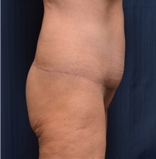 Body Lift After Photo by Michael Frederick, MD; Fort Lauderdale, FL - Case 35892