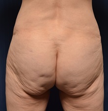 Body Lift Before Photo by Michael Frederick, MD; Fort Lauderdale, FL - Case 35893