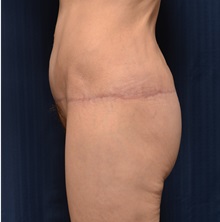 Body Lift After Photo by Michael Frederick, MD; Fort Lauderdale, FL - Case 35893