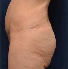 Body Lift Before Photo by Michael Frederick, MD; Fort Lauderdale, FL - Case 35893
